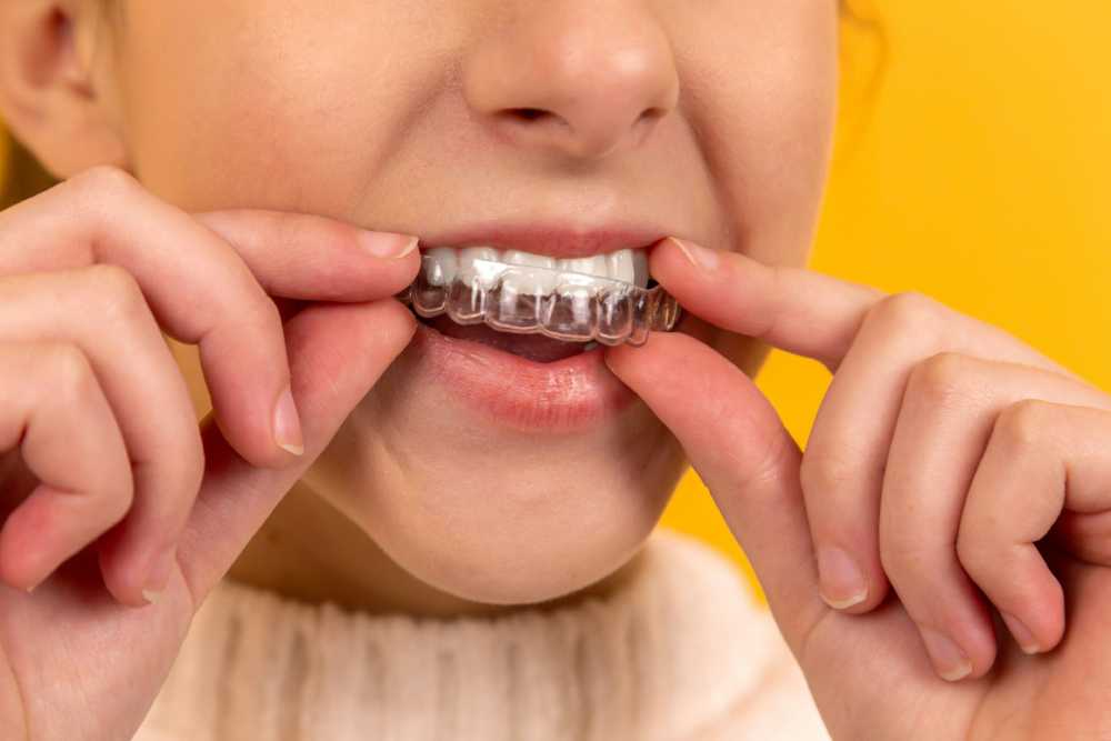 Understanding the Impact of Invisalign on Dental Health and Lifestyle in Chicago